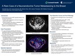 A Rare Case of a Neuroendocrine Tumor Metastasizing to the Breast by Danielle Katz, Aryana Sharrak, Mariam Khan, Jessica Thompson, and Mathew Chung