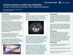A Case of SBO After Initiating Ozempic