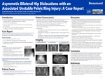 Asymmetric bilateral hip dislocations with an associated unstable pelvic ring injury: A Case Report