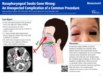 Nasopharyngeal Swabs Gone Wrong:  An Unexpected Complication of a Common Procedure