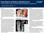 Case Report of Bullous Diabeticorum: A self-limiting condition with potentially devastating consequences by Taylor Allison and Randy Semma