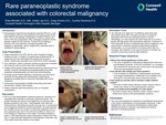 Rare paraneoplastic syndrome  associated with colorectal malignancy